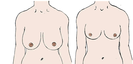 Cirurgia redução de mama Preços e informações Cirurgia redução de mama Preços e informações