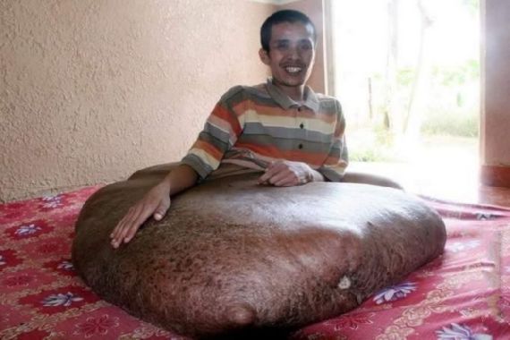 Homem tem tumor de 80 kg e 1m de largura
