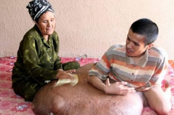 Homem tem tumor de 80 kg e 1m de largura Homem tem tumor de 80 kg e 1m de largura