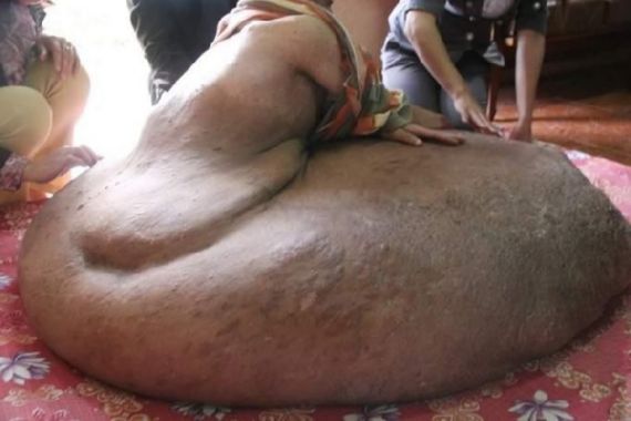 Homem tem tumor de 80 kg e 1m de largura Homem tem tumor de 80 kg e 1m de largura