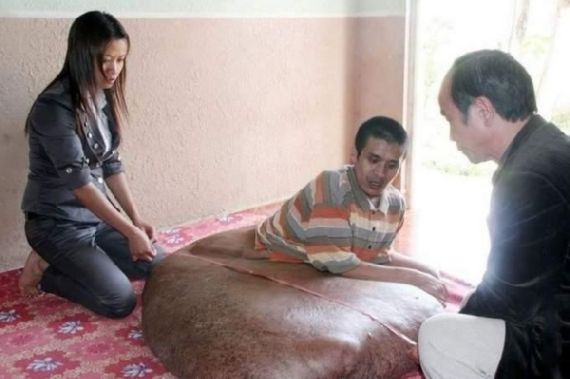 Homem tem tumor de 80 kg e 1m de largura Homem tem tumor de 80 kg e 1m de largura