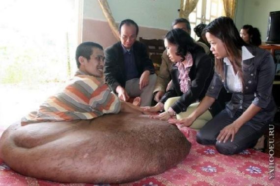 Homem tem tumor de 80 kg e 1m de largura Homem tem tumor de 80 kg e 1m de largura