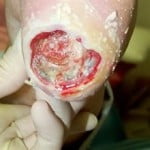 Calcanhar de Maracujá: O que é? Imagens e vídeos