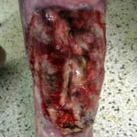 Calcanhar de Maracujá: O que é? Imagens e vídeos