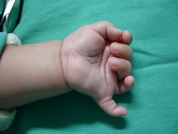 Polidactilia o que é? Polidactilia o que é?