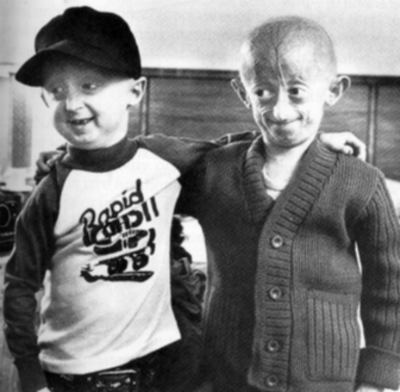 Progeria, crianças com aparência de velhos