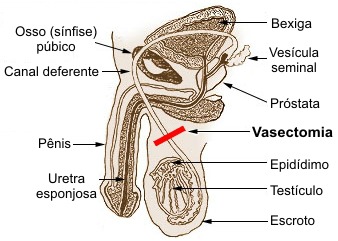 Vasectomia   Como funciona?