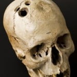 Você sabe o que é Trepanação?
