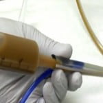 Bacterioterapia fecal: Saiba como funciona a transfusão de cocô
