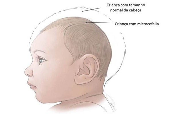 criança-microcefalia